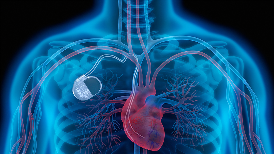 Mirmex Motor | Active Implants Mirmex Motor | Active Implants